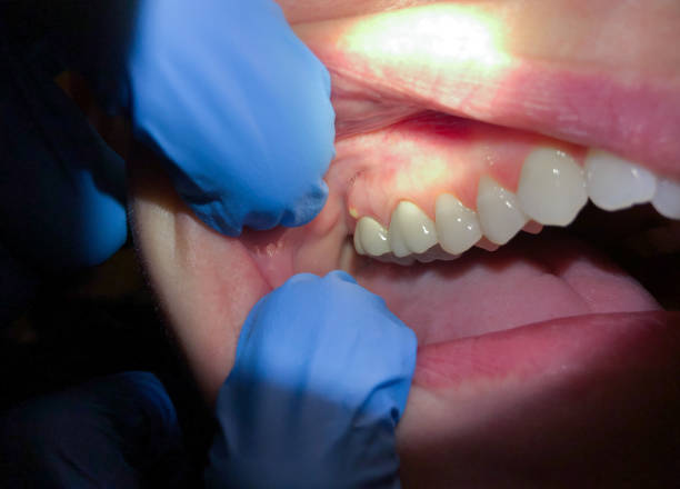Best Knocked-Out Tooth (Avulsed Tooth) Treatment in Clyde, NC
